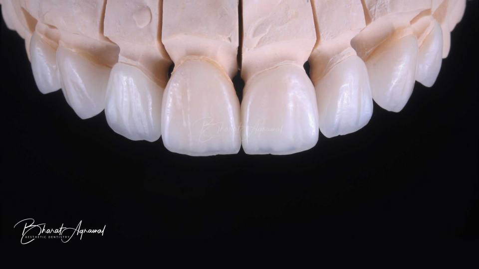porcelainveneer
