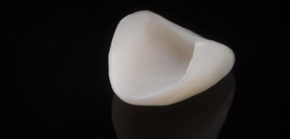 single-porcelain-veneer