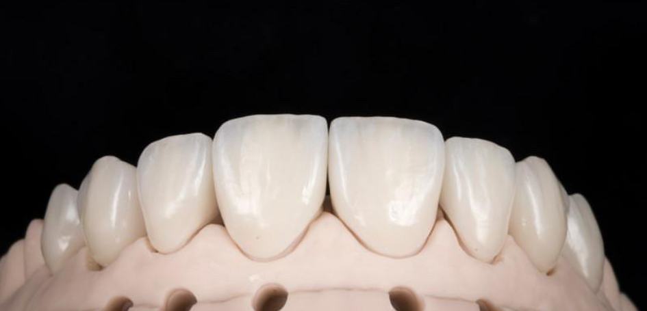 veneers-ready-for-placement
