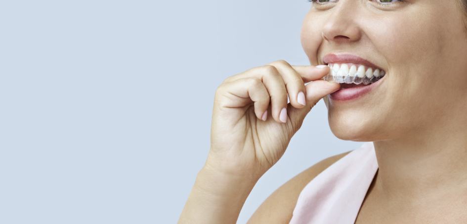 invisalign-aligner-insert-woman