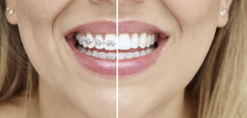 invisalign-vs-braces