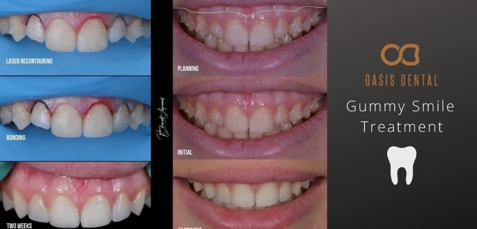 gummy-smile-treatment
