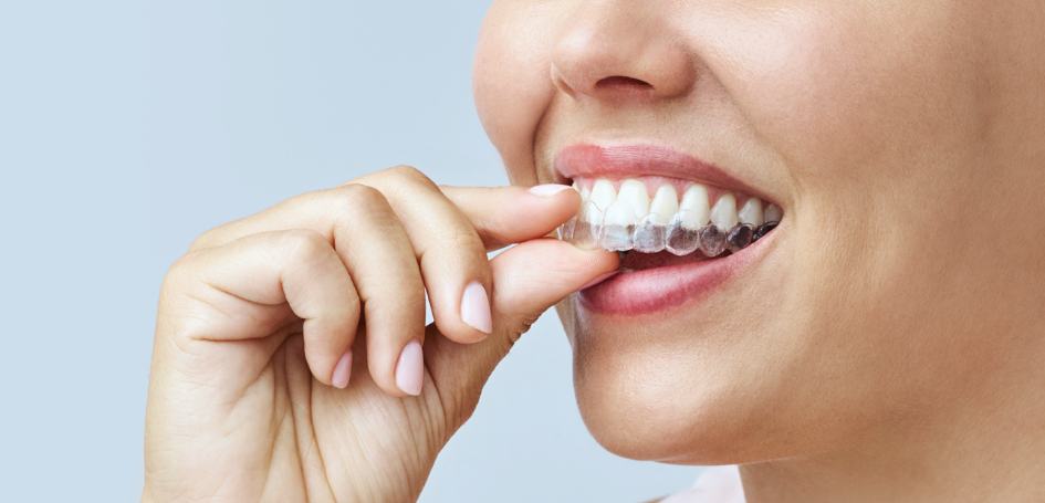 invisalign