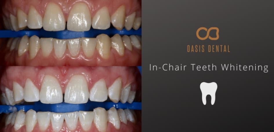 teeth-whitening-gold-coast-before-after