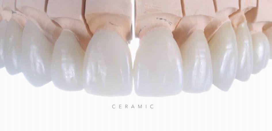 porcelain-veneers