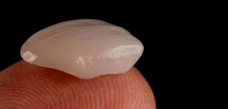 porcelain-veneer-gold-coast