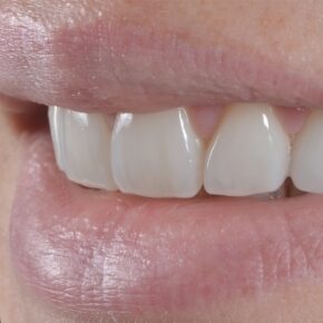Porcelain veneers & teeth whitening at Oasis Dental 02